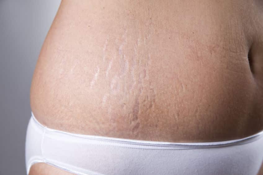 مكافحة السيلوليت وعلامات تمدد الجلد