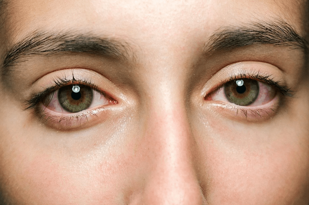 حساسية العين