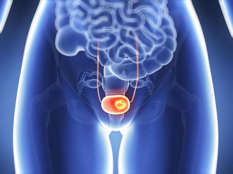 التهاب المثانة من أسباب آلام الحوض عند المرأة