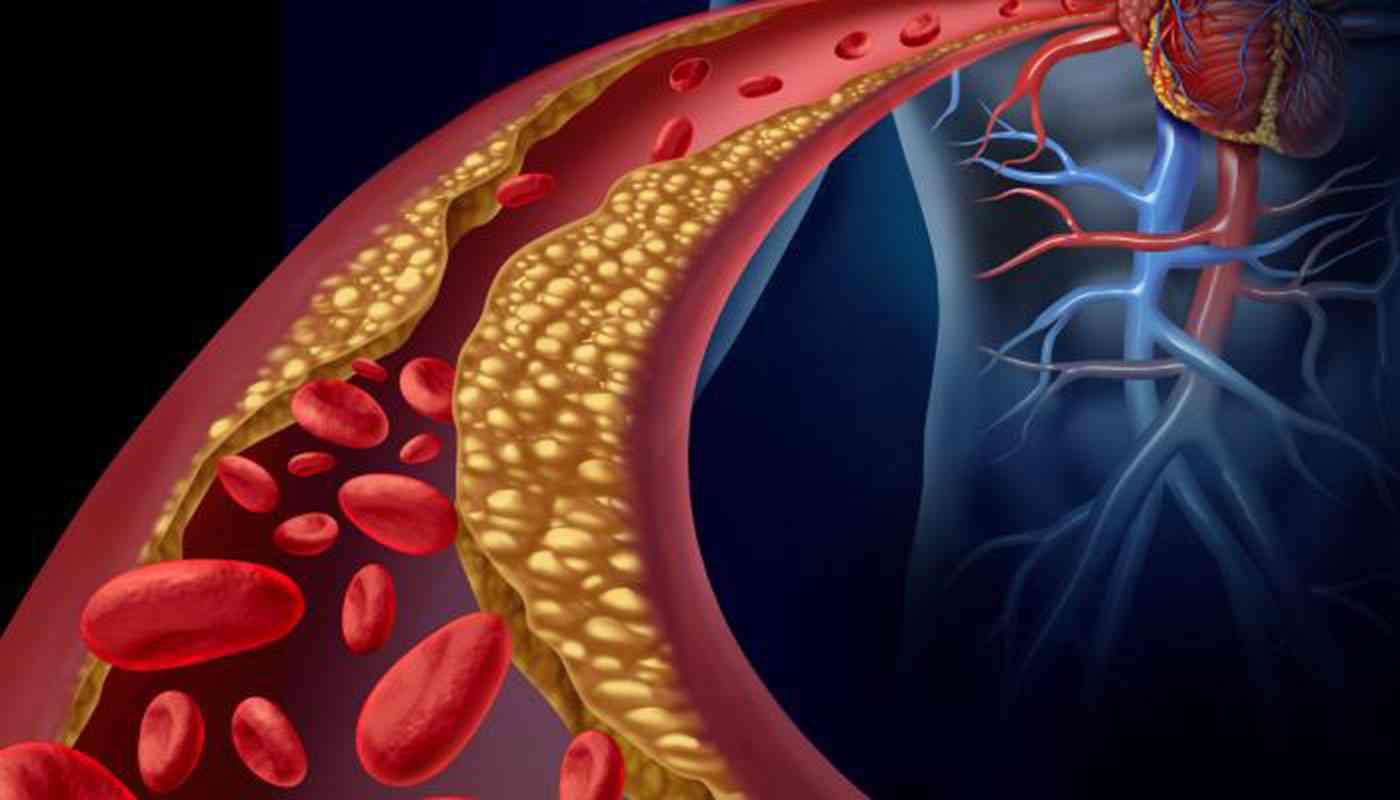 تخفيض نسبة الكوليسترول الضار بالدم