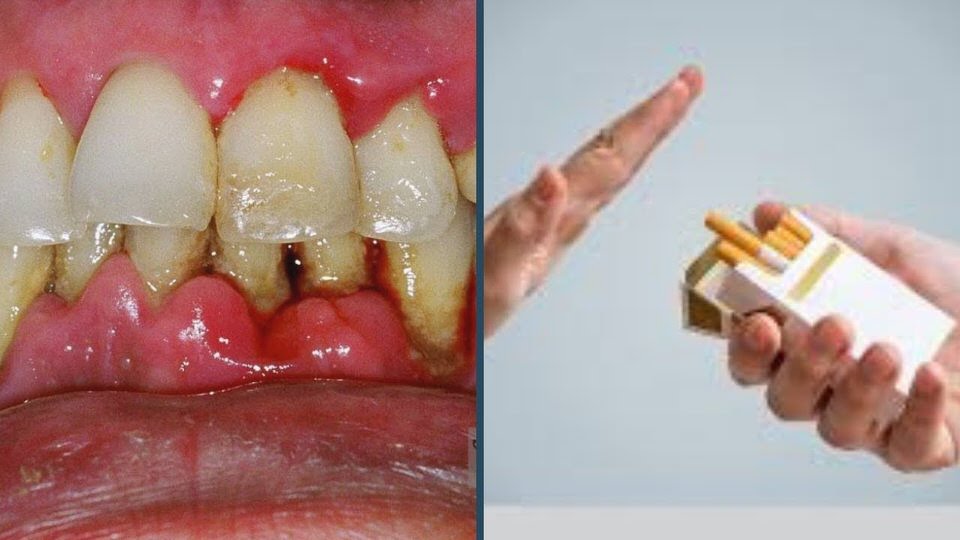 ضرر التدخين على الأسنان واللثة