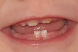 التأثير السلبي على الأسنان