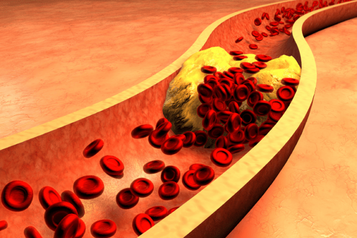 التقليل من خطر الإصابة بفَرط ثلاثي غليسيريد الدم