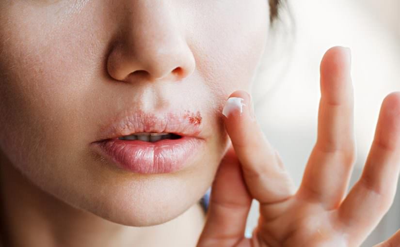 علاج الأمراض الجلدية وتقرحات الفم